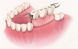 歯を抜く治療